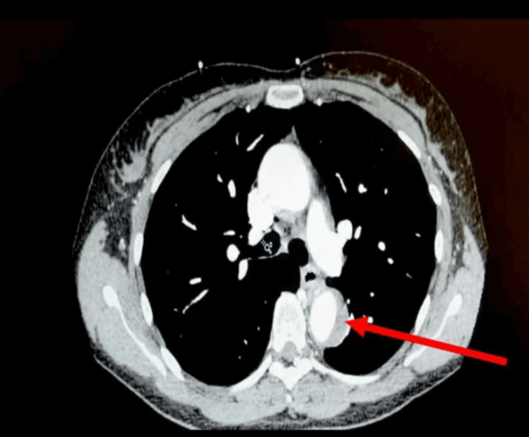 Woman almost died during sex when orgasm popped aorta