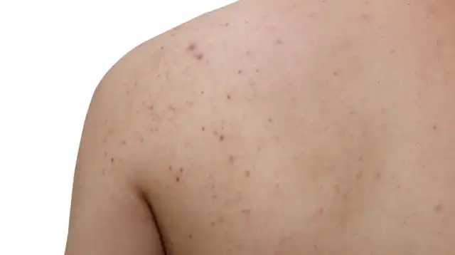 This is the perfect product to use if you suffer from stubborn body acne This is the perfect product to use if you suffer from stubborn body acne